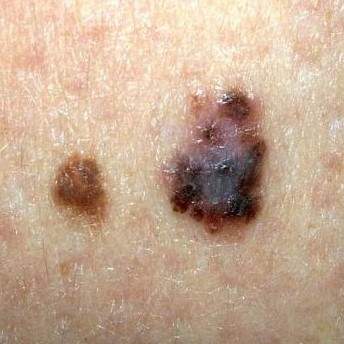 Melanoma - Clinical Pediatrics is a full service pediatric clinic ...